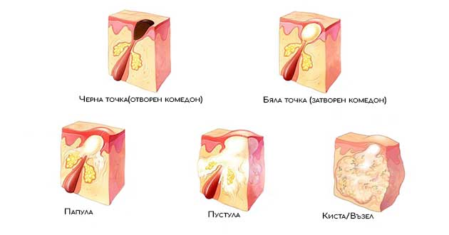 стадии на акне