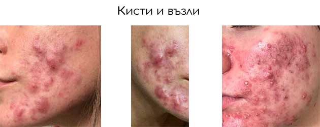 кистозно акне и възли